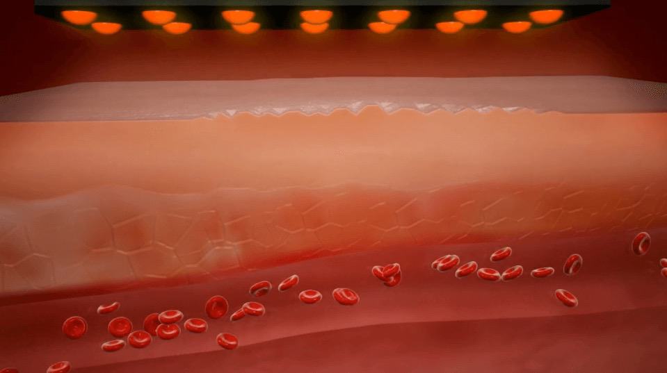 Infrared light therapy for joint pain delivered via flexible LED pad applied directly to the skin in clinical at-home photobiomodulation session